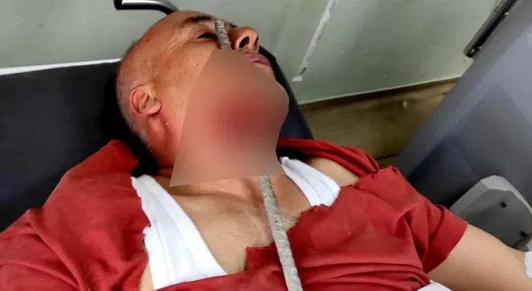 Hatay İskenderun'da İnşaatta Yüzüne Demir Saplanan İşçi Ölümden Döndü